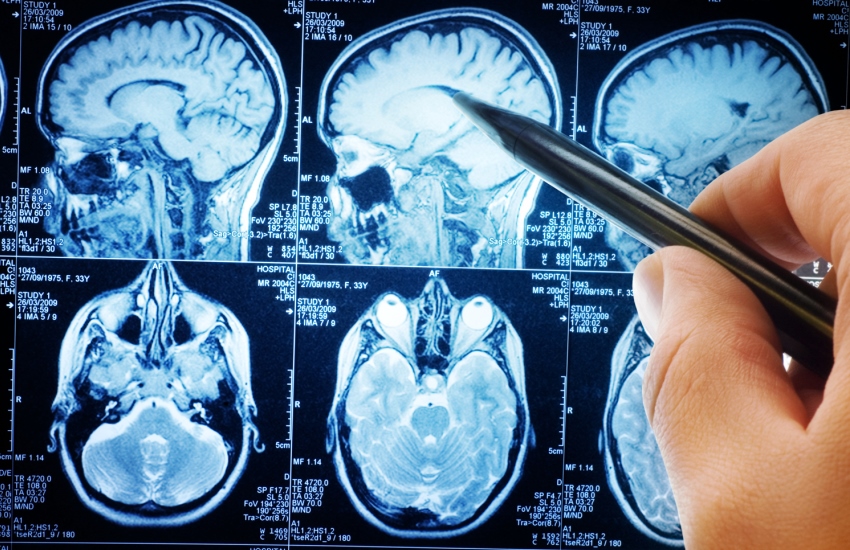 tumori al cervello intel labs